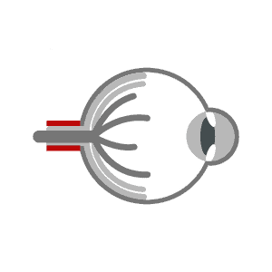 glaucoma