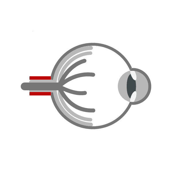 glaucoma