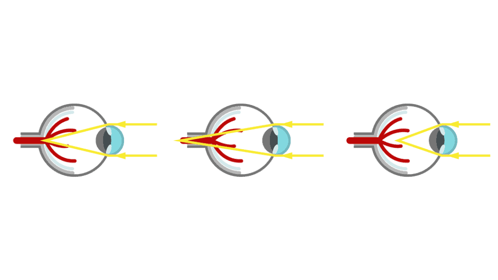 occhio miope e occhio ipermetrope