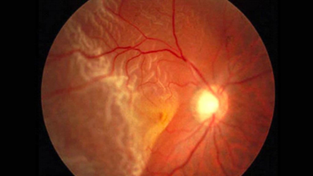 occhio con distacco retina