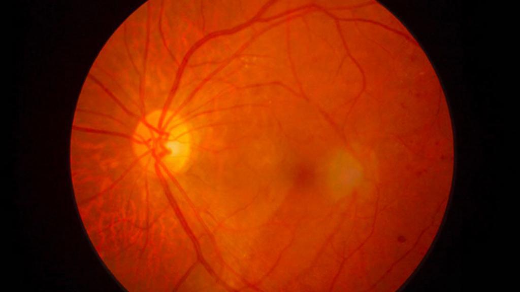 distacco retina