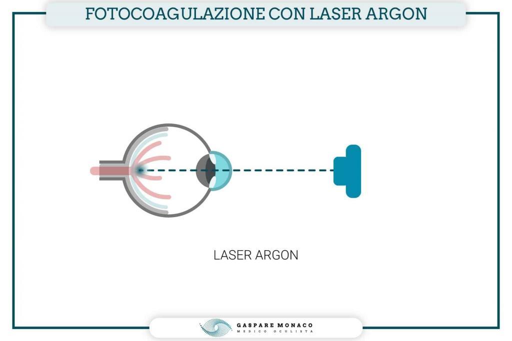 laser argon
