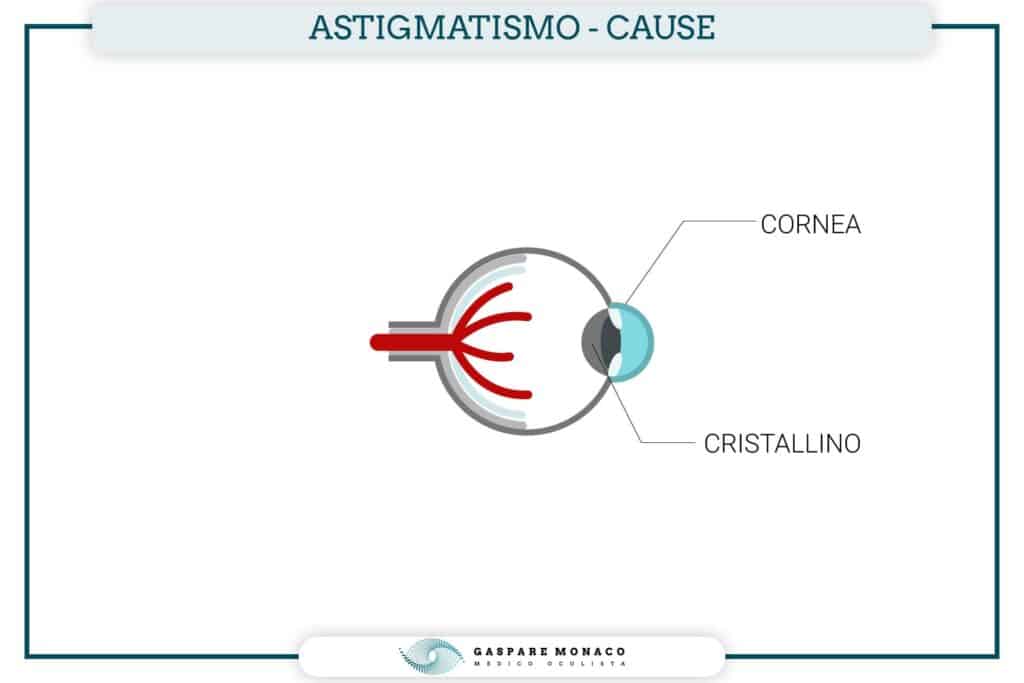 astigmatismo cause