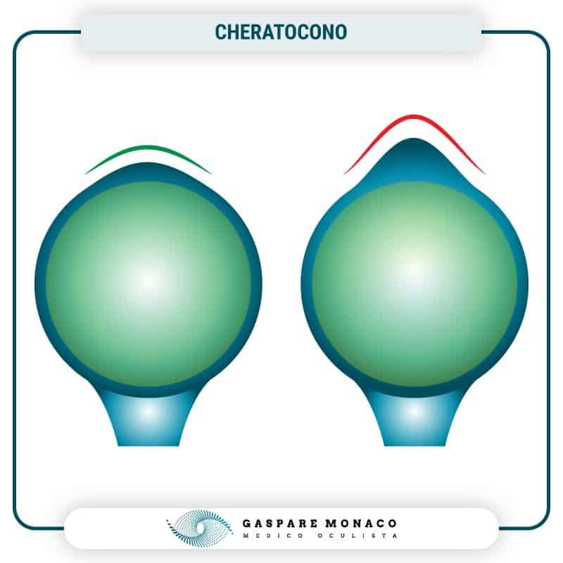 Cheratocono Cross Linking