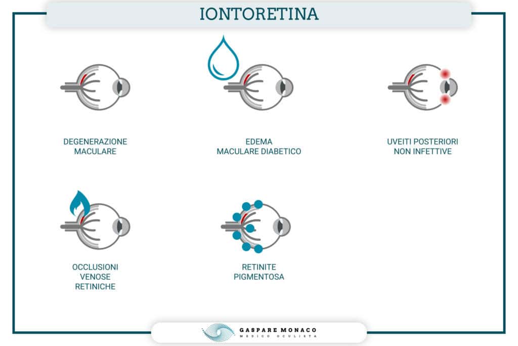 iontoretina